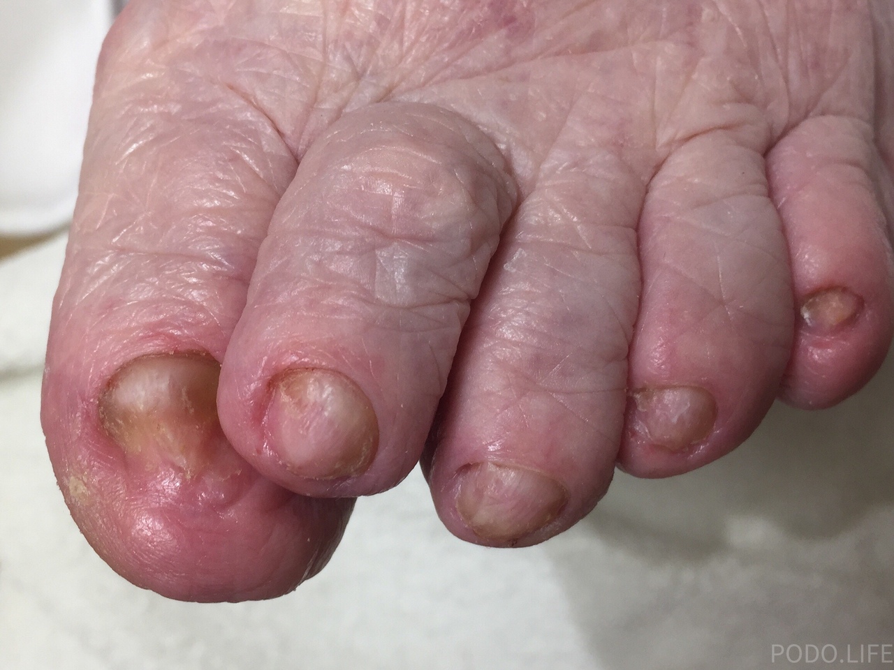 Домашние способы, помогающие размягчить и подстричь ногти на ногах пожилому человеку