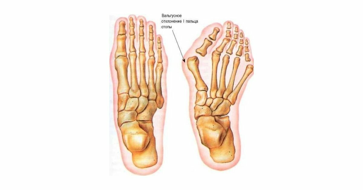 Стопы ног вальгус